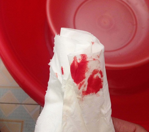 Đại tiện ra máu